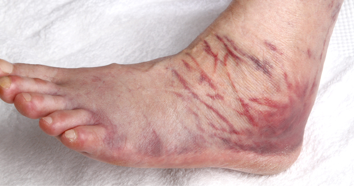 Ankle Swelling & Discoloration